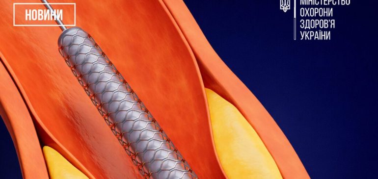 В Україні розширили доступ до безоплатного планового стентування судин серця